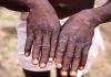 Monkeypox: मंकीपॉक्स क्यों फैल रहा है, क्यों यह कोरोना वायरस जितनी तेजी से संक्रमित नहीं कर रहा है, पर कोविड से ज्यादा खतरनाक है, जानें सबकुछ